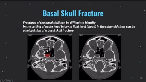 Basilar Skull Fractures